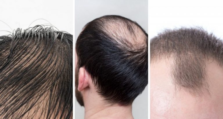 Semakin Dekat Majlis, Semakin Banyak Rambut Pengantin Lelaki Gugur