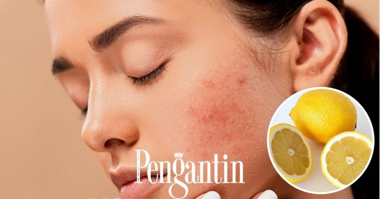Nak Kahwin? 5 Cara Alami Ini Paling Cepat Untuk Kecutkan Jerawat Sebelum Jumpa Tok Kadi!