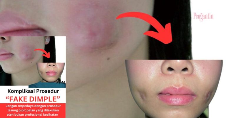 Buat Pembedahan Lesung Pipit ‘Palsu’ Sebab Nak Cantik, Akhirnya Pipi Bengkak, Bernanah